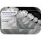 Advanced Intraoral Dental Digital X Ray Machine With High-Resolution Sensor