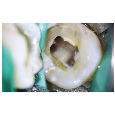 엔도테모돈틱스를 위해 제거할 수 있는 100V-240V 치아 수술용 현미경